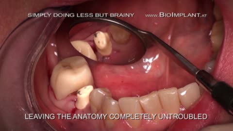 IMMEDIATE CERAMIC IMPLANT WITHOUT ANY SURGERY IN HALF A MINUTE