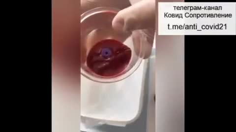 Chinese "cupping" removal of COVID Vaccine.