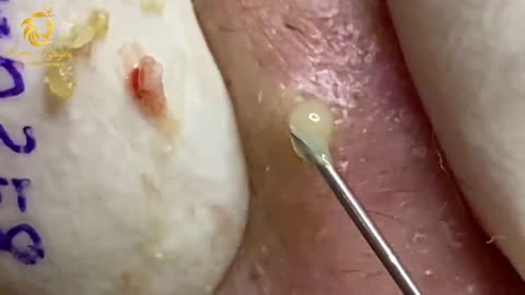 Acne treatment
