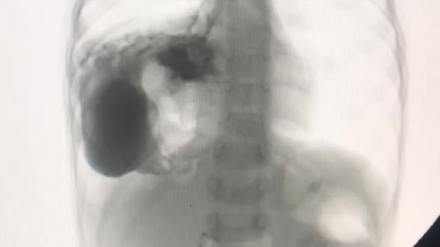 Barium swallow of 3 year old baby.