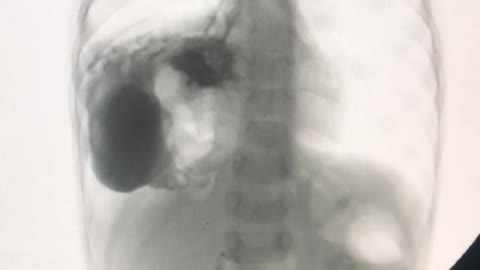 Barium swallow of 3 year old baby.