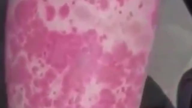 打完疫苗,嚴重紅斑