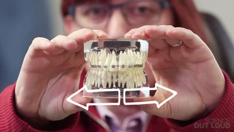 How Do Braces Work?