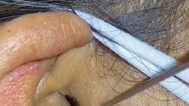 How to remove blackheads from nose, pop pimples, acne treatment #64 #shorts