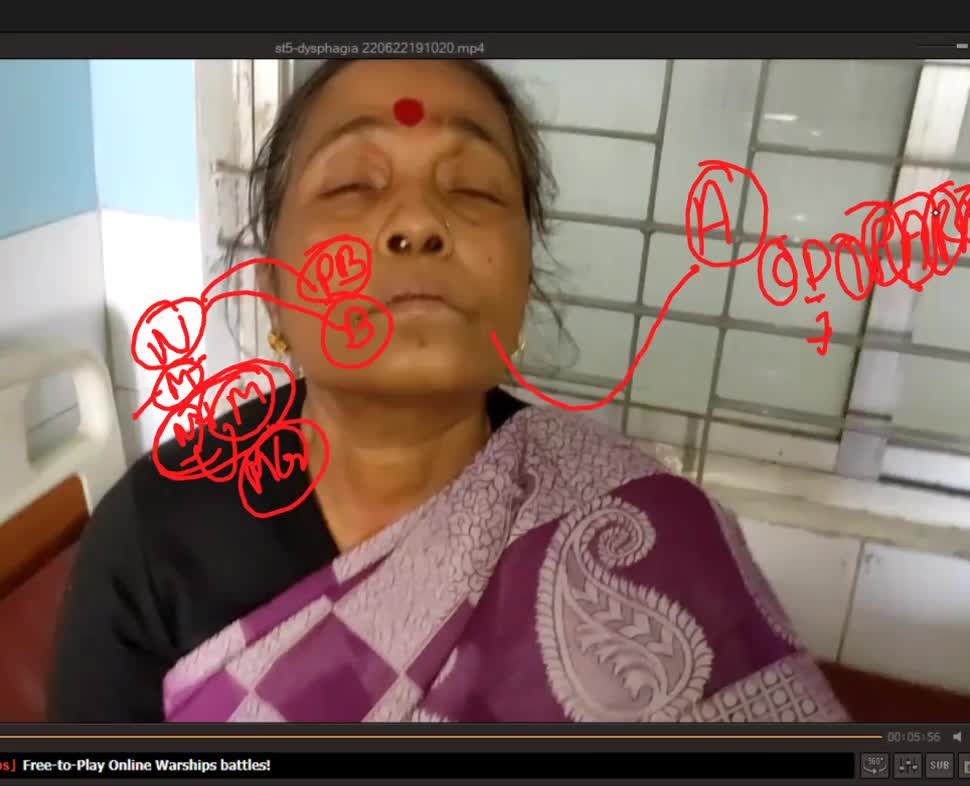 ST5.45 year old lady with difficulty swallowing discussion Jannat