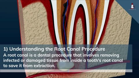 Your Guide to Understanding Root Canal Procedure Timelines