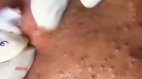 bloody blackheads!