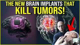 Brain Chips To Kill Tumors?