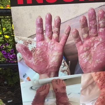 RIP those killed by the jab.