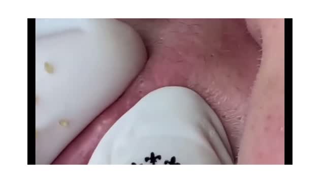 Relax Time Acne