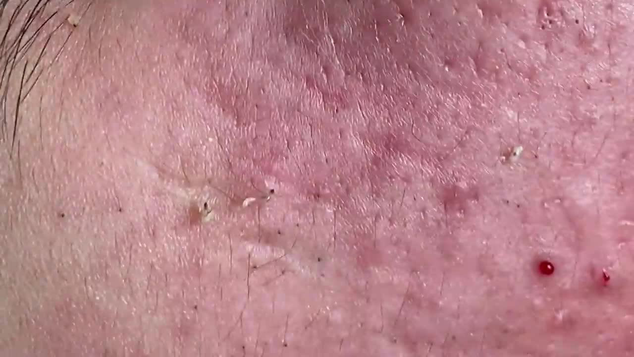 #067 | Acne Treatment Huong Beauty | Part 2 - On the cheek