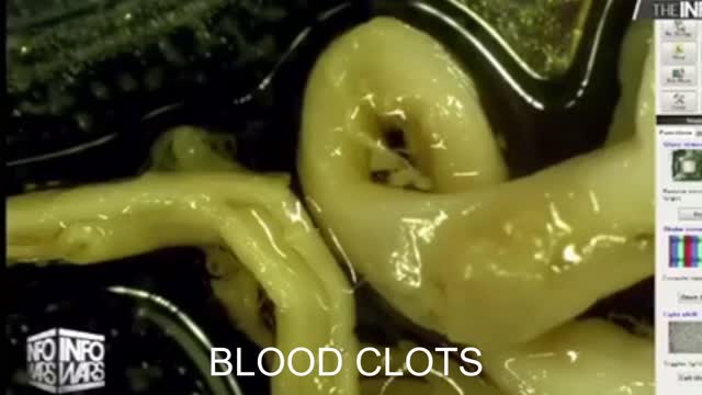 Blood Clots