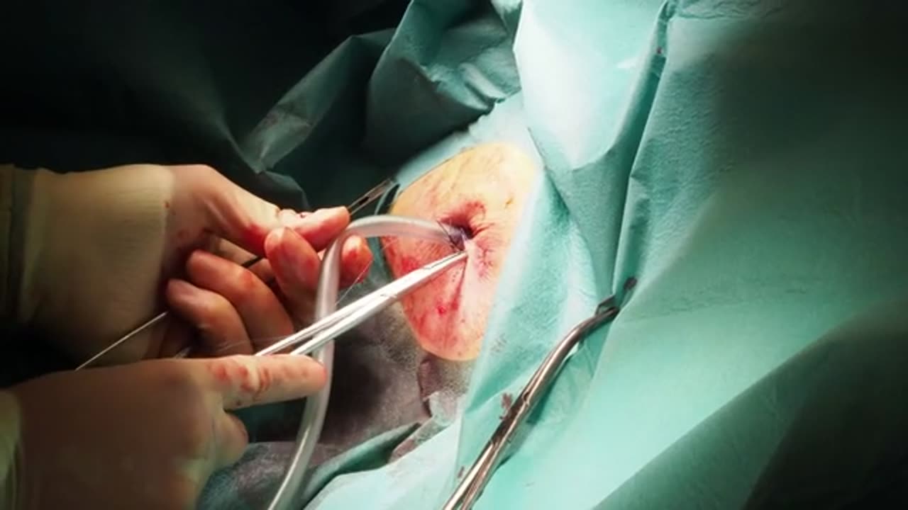 Surgical insertion of a chest tube CSurgeries