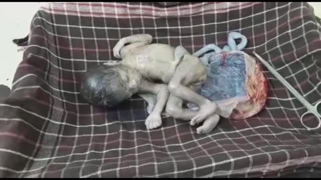 Seven Months Baby Born in Critical Condition