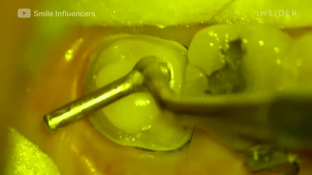 How Damaged Teeth Are Professionally Restored _ Refurbished _ Insider
