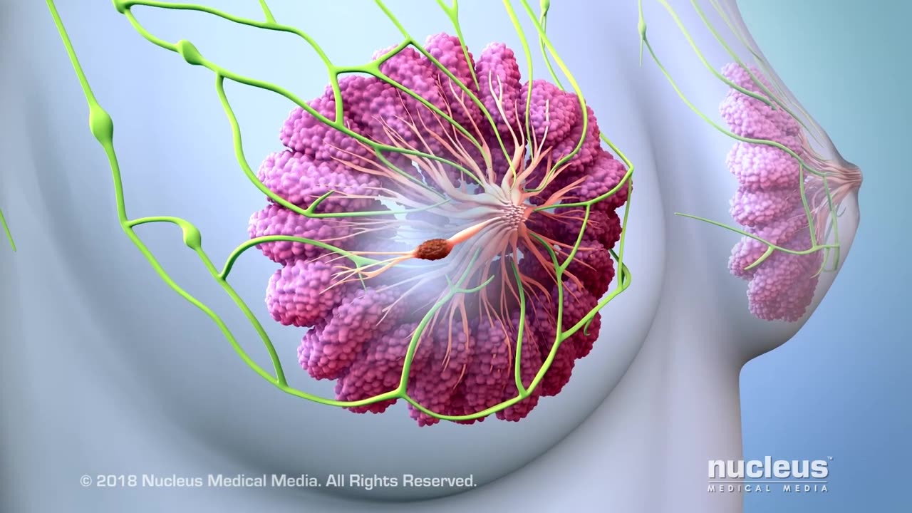 What are Some of the Treatment Options for Breast Cancer