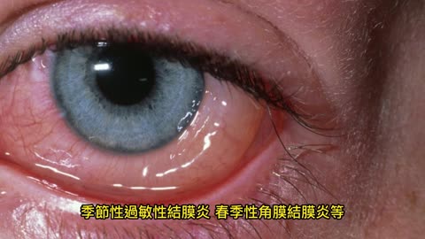 眼睛紅癢痛 過敏性結膜炎