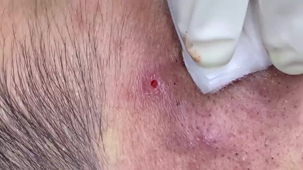 Big Cystic Acne Blackheads Extraction Blackheads & Milia, Whiteheads Removal Pimple Popping