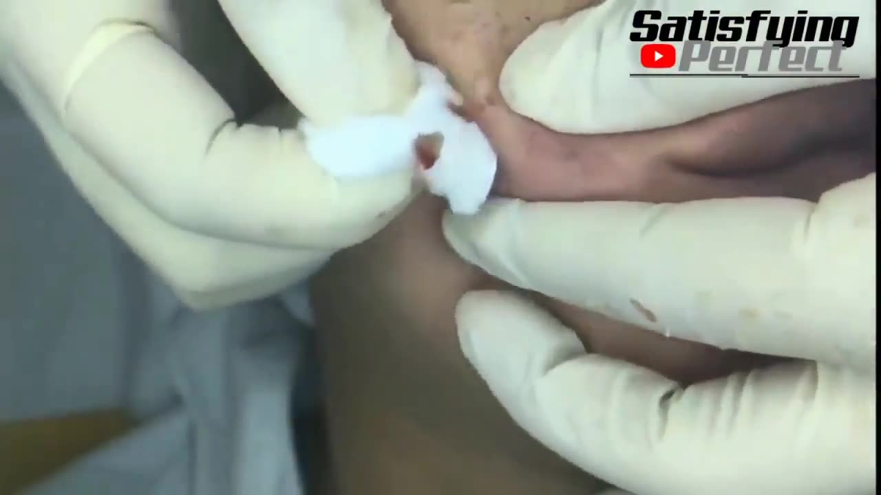 BIG CYST POPPING!!!CRAZY EXPLOSION VIDEO !!!