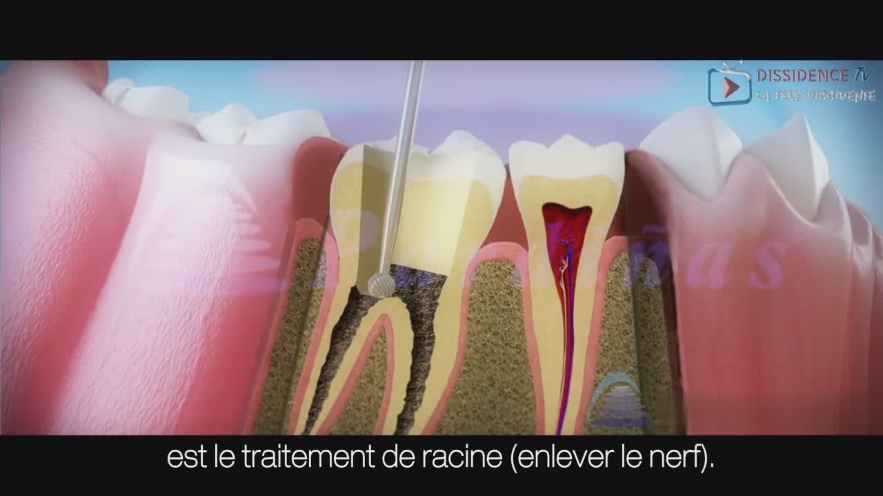 Traitement de la carie profonde par dévitalisation