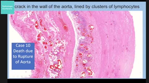 German pathologists discussed pathology caused by C19-SADS Clotshots