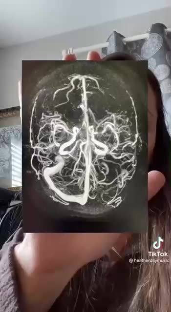 Brain injury from covid vaccine_2022