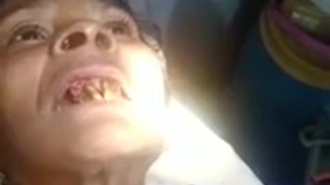 poor oral hygiene: worms inside mouth; a case from Chhattisgarh