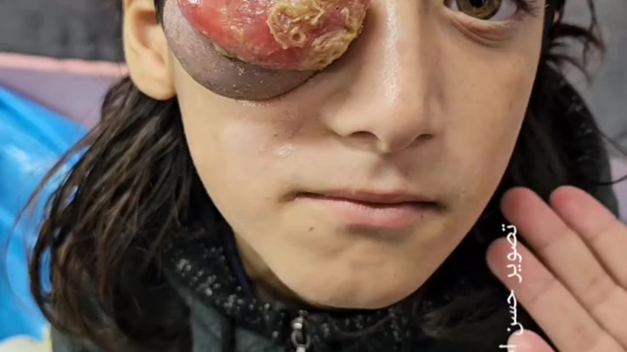 Ahmed Sabra, 10 years , developed a cancerous eye tumor