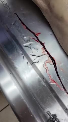 Unwatchable: Vaccinated Related Blood clots “This Is Not Normal!!”