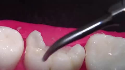 Treatment of Teeth (middle)