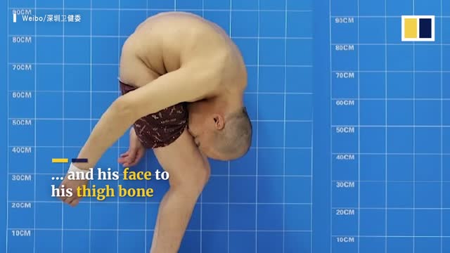 Folded man’ stands up straight after 28 years following surgery that broke bones