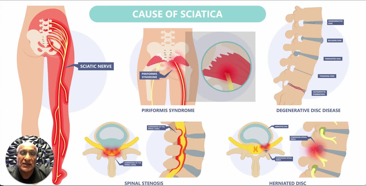 Causes Of Sciatica | Padda Institute Of Pain Management | St Louis