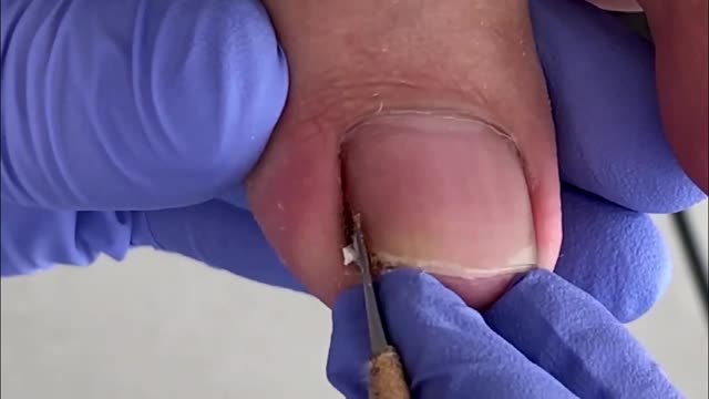 Manchas negras en las uñas de los pies (I)