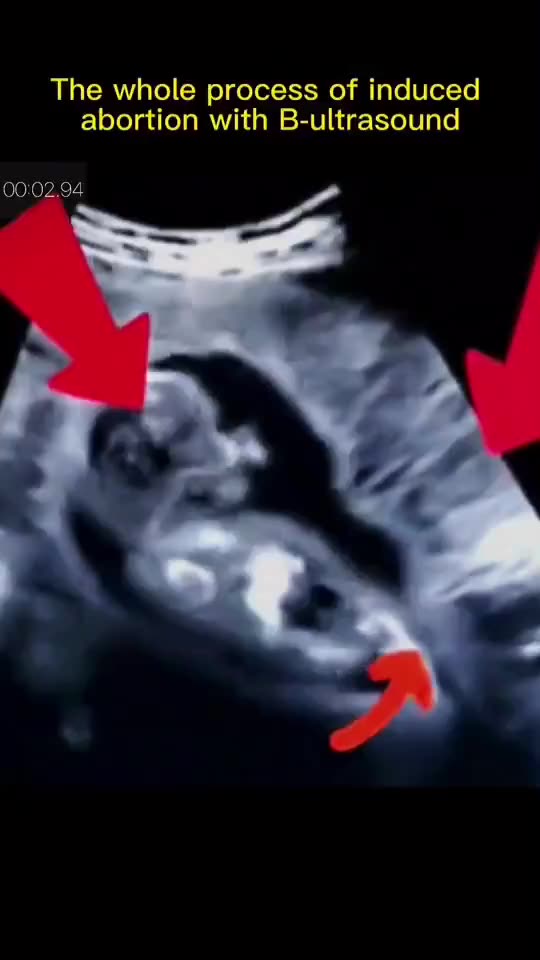 Women Who Have Abortions Have Had At Least One Already!