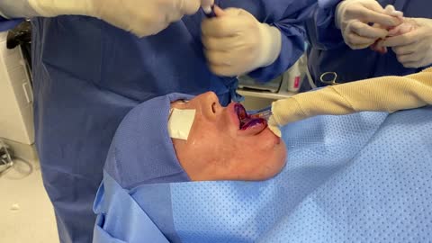 Plastic Surgery Procedure -- Surgical Removal of Illegal Silicone Injections from the Upper and Lower Lips