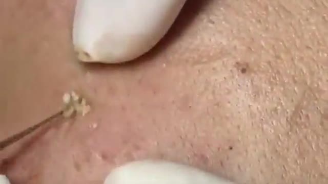 LARGE Blackheads Removal - Best Pimple