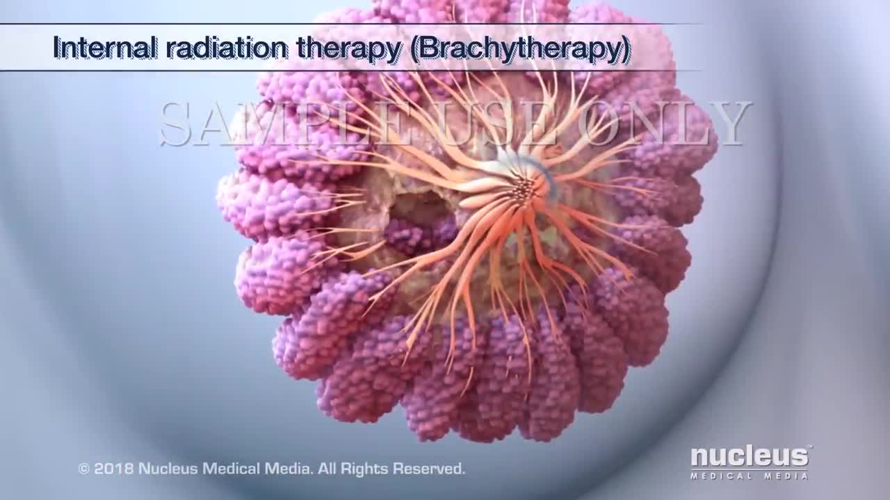 Breast Cancer Treatment