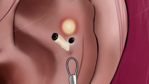 Asmr deep ear removal