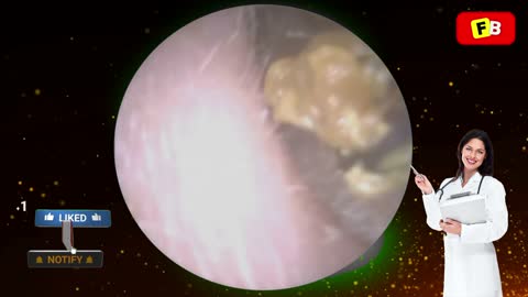 Ear Wax Removal PART 11