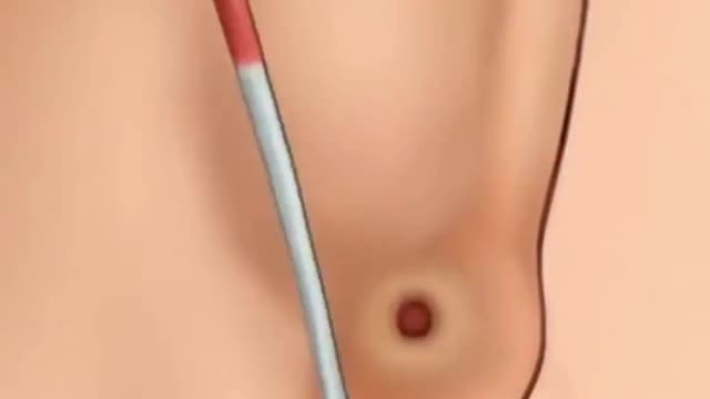 ASMR Removal Satisfying Video