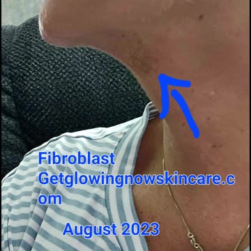 Fibroblast