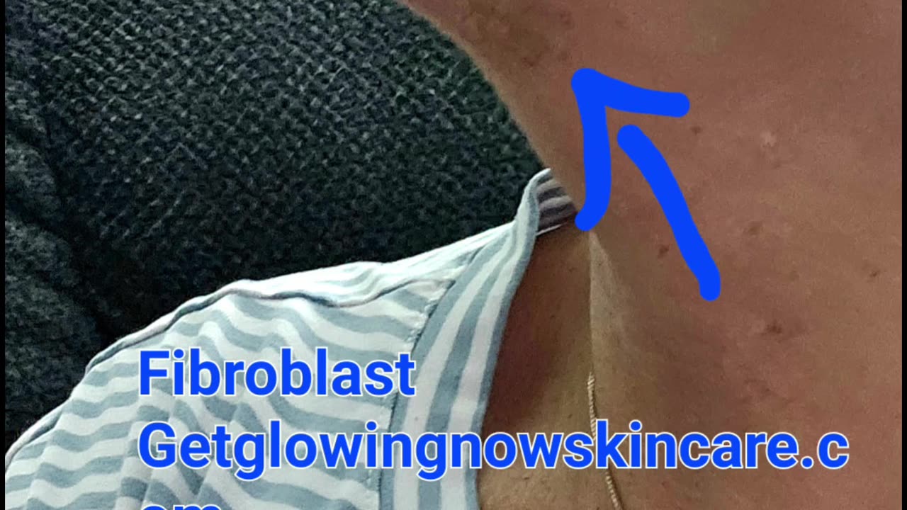 Fibroblast