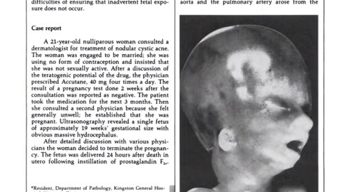 Skincare Industry Scam Isotretinoin and Vitamin A Toxicity