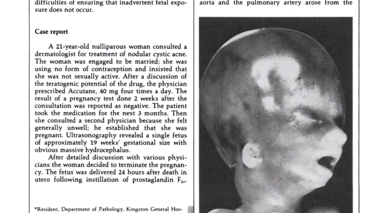Skincare Industry Scam Isotretinoin and Vitamin A Toxicity