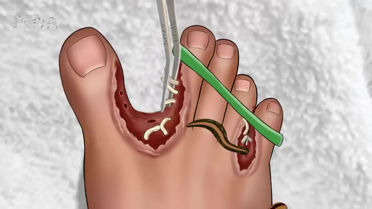 Infection in your foot poison