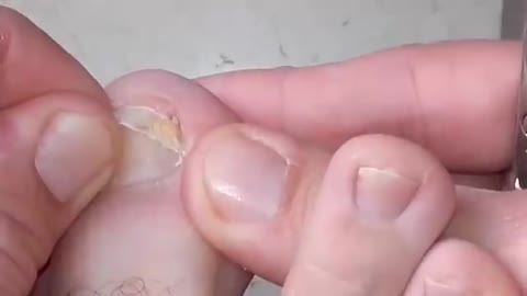 Ingrown toenails removal