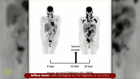 Vaccine Causes Rapid Progression Of Cancer In Famous Pro-Vaccine Doctor