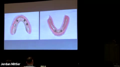 How to Plan a Full Arch Maxillary Prosthetic Restoration Virtually