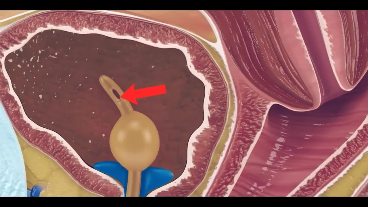 Foley catheter, its insertion and Function