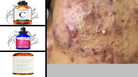 Blackheads Removal & Pimple Popping Videos 2020